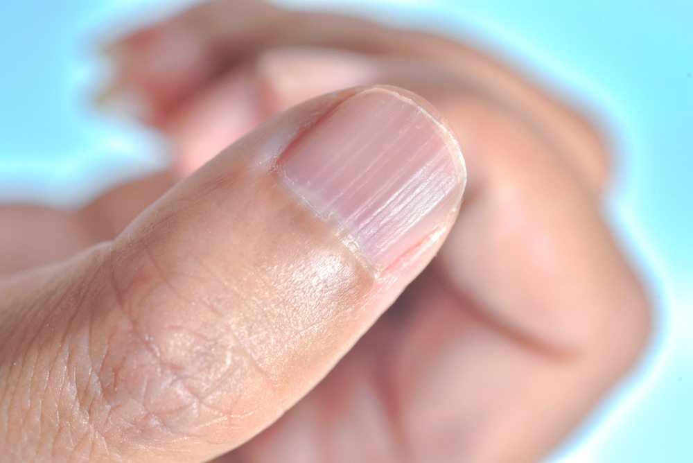 Was bedeuten Rillen auf den Fingernägeln? ➤ Globenow.info