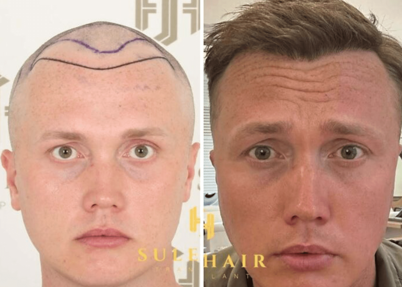 Wie eine Haartransplantation das Aussehen verändert: Vorher-Nachher-Bilder und Expertenmeinungen